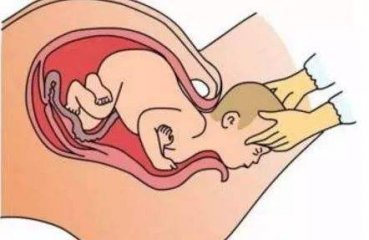 孕妇突然分娩该怎么办？