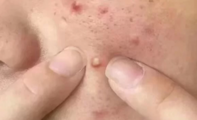 痤疮会不会长一辈子吗？最晚长到什么年纪