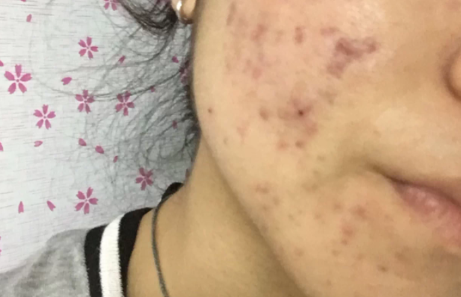 痤疮多久能恢复成正常皮肤