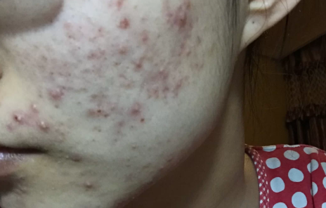 痤疮最晚长到什么年纪