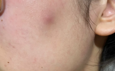 痘痘已经平了，但是没全好可以化妆吗