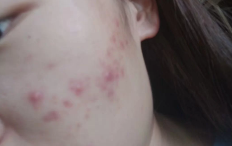 痘痘已经平了一直红着多久能消