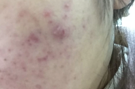 痘痘由红变黑是好转吗