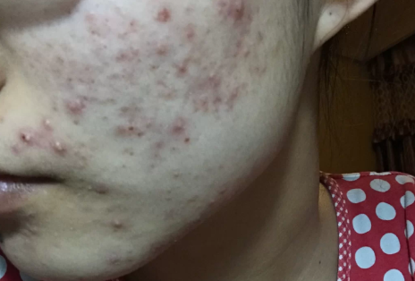 无脓头很大很硬的痘痘怎么处理