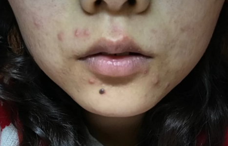 痘痘消不了摸起来里面是硬的