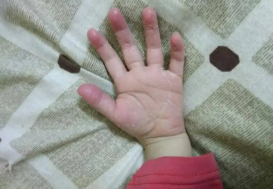 手脱皮是什么原因导致的