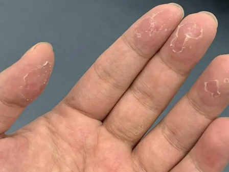 手脱皮吃什么维生素最好