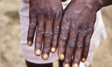 猴痘病毒有疫苗吗