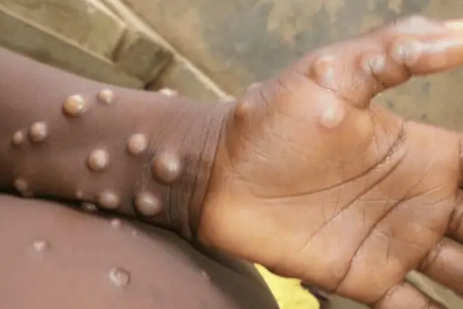 猴痘的常见症状有哪些