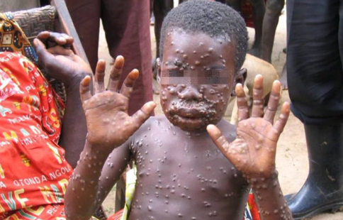 猴痘传病毒通过什么传播