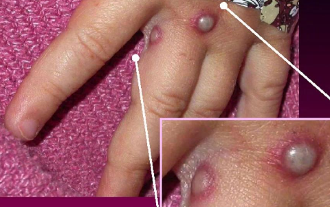 猴痘传病毒会人传人吗