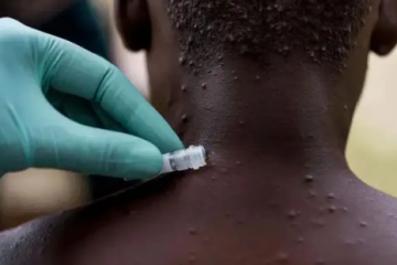 猴痘病毒有疫苗吗