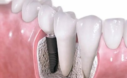 牙齿根部掉了一小块有凹洞如何解决