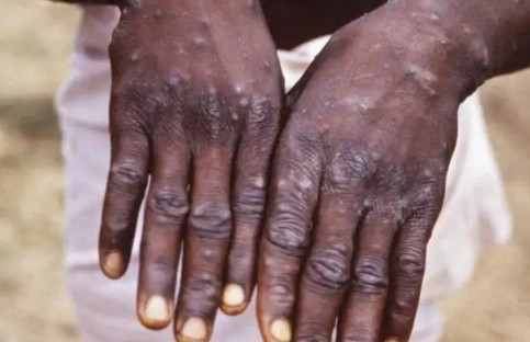 2022年中国有猴痘病毒吗